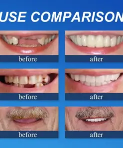 Cavebit™ Medical Full Denture with Strong Suctiond